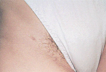 Caso practico de depilación femenina antes