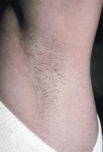 Caso practico de depilación masculina antes