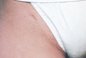 Caso practico de depilación femenina después