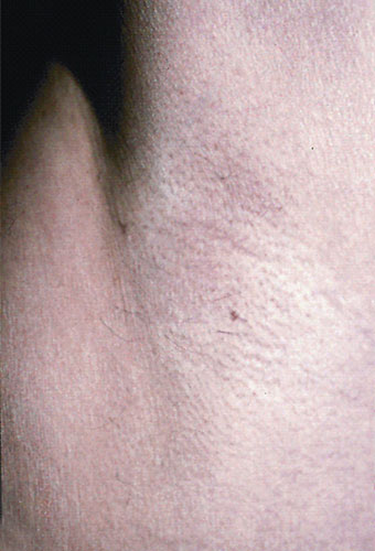 Caso practico de depilación masculina después