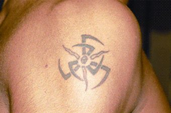 Eliminación de tatuaje antes del tratamiento