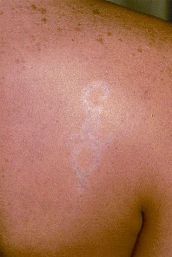 Eliminación de tatuajes después del tratamiento