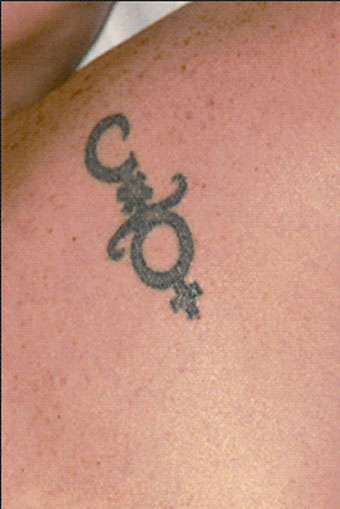 Eliminación de Tatuajes antes del tratamiento