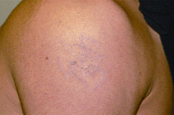 Eliminación de tatuajes después del tratamiento